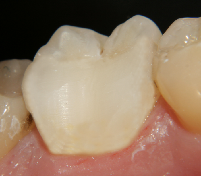 Зъбът е възстановен с композитен материал